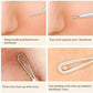 TC Blackhead Pimple Remover Comedone Spot Acne Extractor Kit Popper Tools